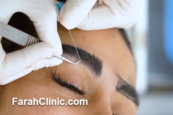 آشنایی با مزایای کاشت ابرو در فرح کلینیک