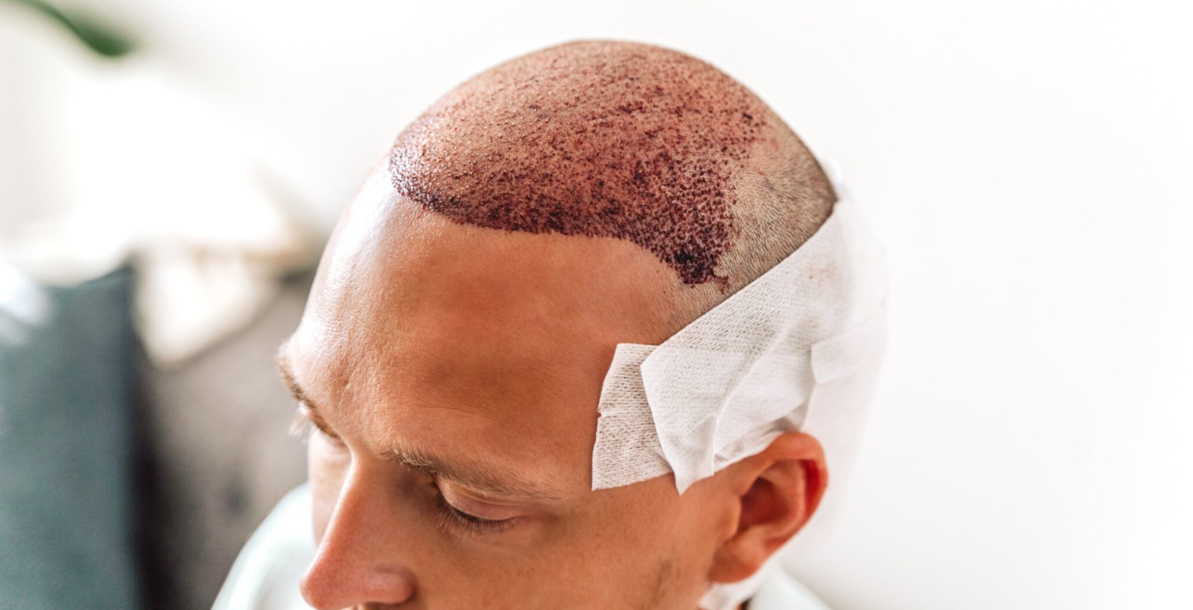 شناخت بهترین روش های کاشت مو