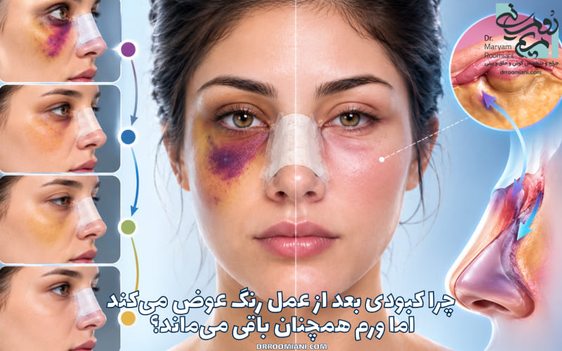 چرا کبودی بعد از عمل رنگ عوض میکند اما ورم همچنان باقی میماند؟