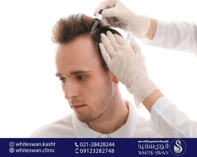 روشهای پیشرفته تقویت مو؛ آشنایی با اس وی اف، لیزرتراپی و پی آر اف مو